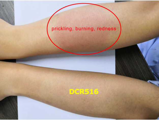 DCR516 irritation relieving test
